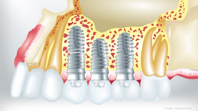 Grafik Zahnimplantate