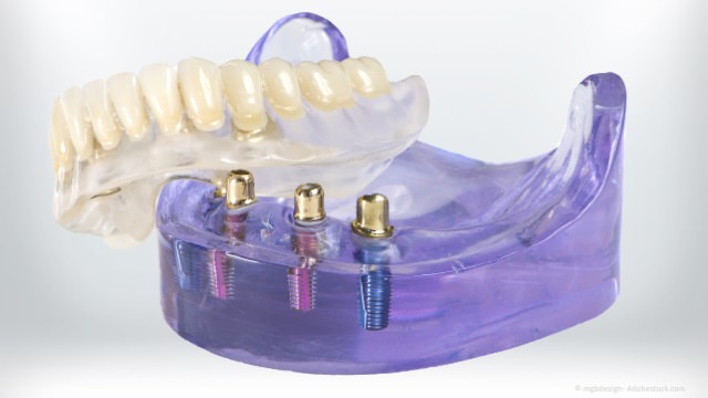Sicherer Sitz von Totalprothesen mit Zahnimplantaten
