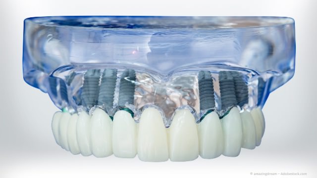 Festsitzende Zahnbrücke auf Implantaten