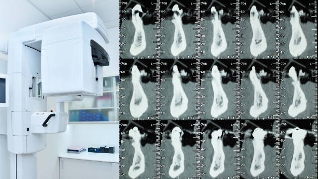 DVT: Dreidimensionale Röntgenaufnahmen der Zähne und Kiefer